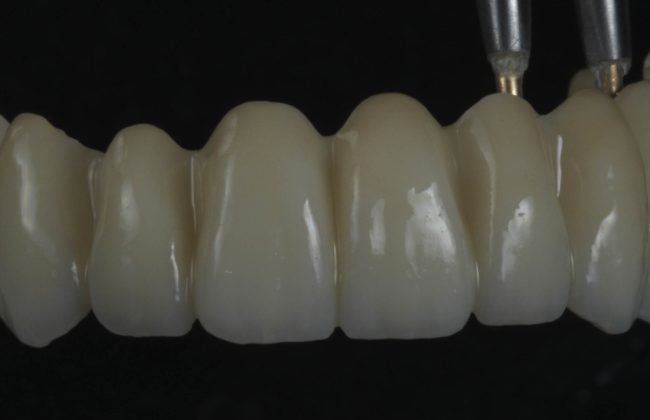 protesis dentales zirconio