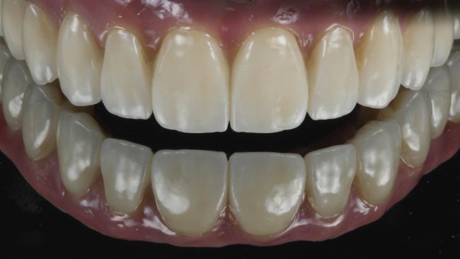 protesis hibrida dental